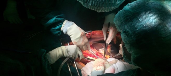 ניתוח השתלת איברים